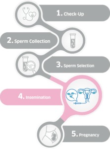 Intra-Uterine Insemination (IUI) | Superior A.R.T.